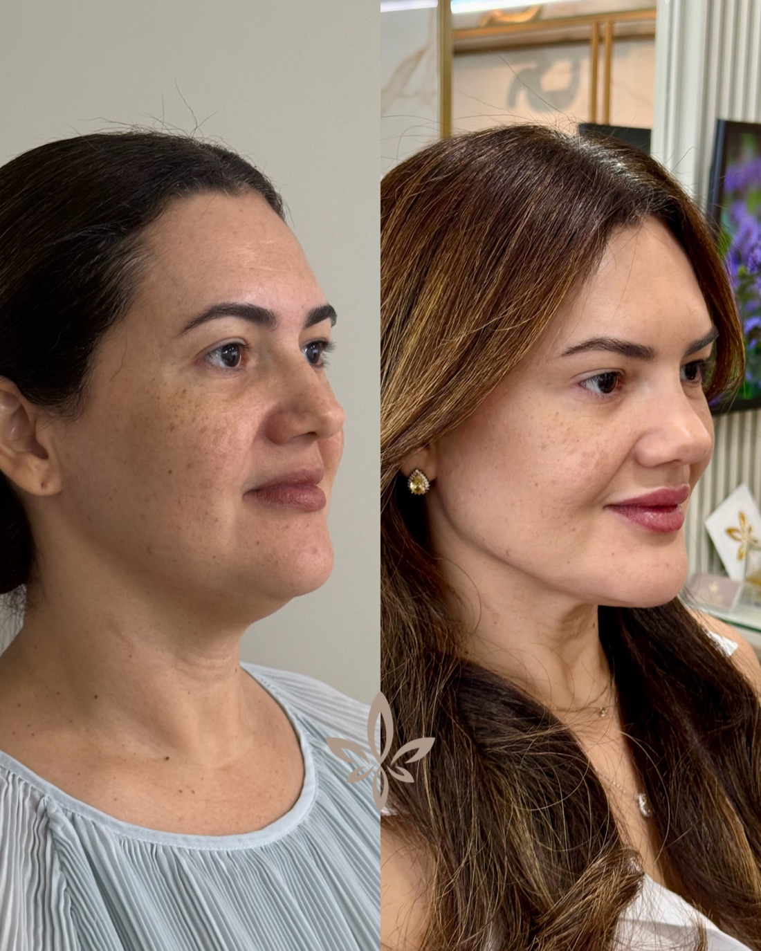 Antes e depois de paciente do Método Éclair