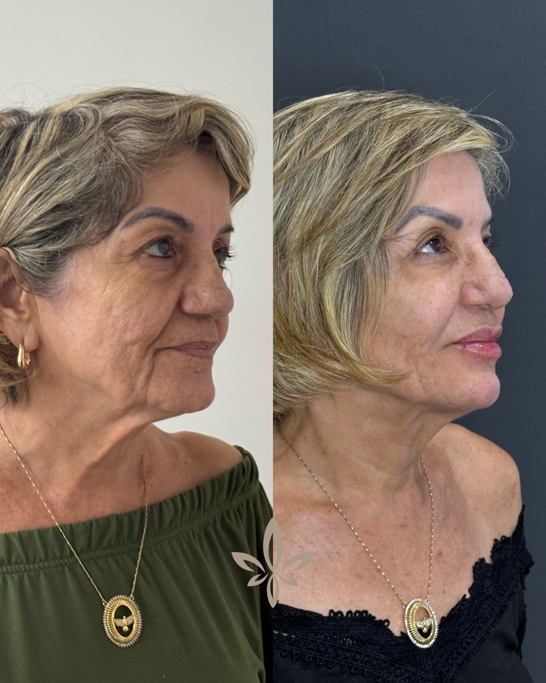 Antes e depois de paciente do Método Éclair