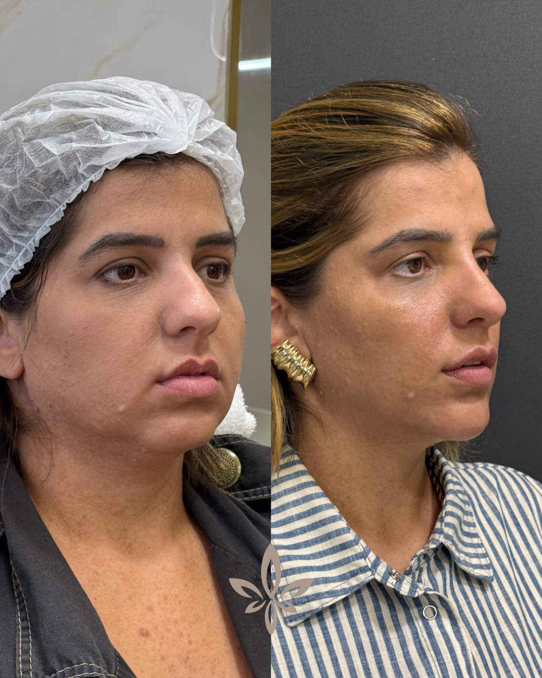 Antes e depois de paciente do Método Éclair
