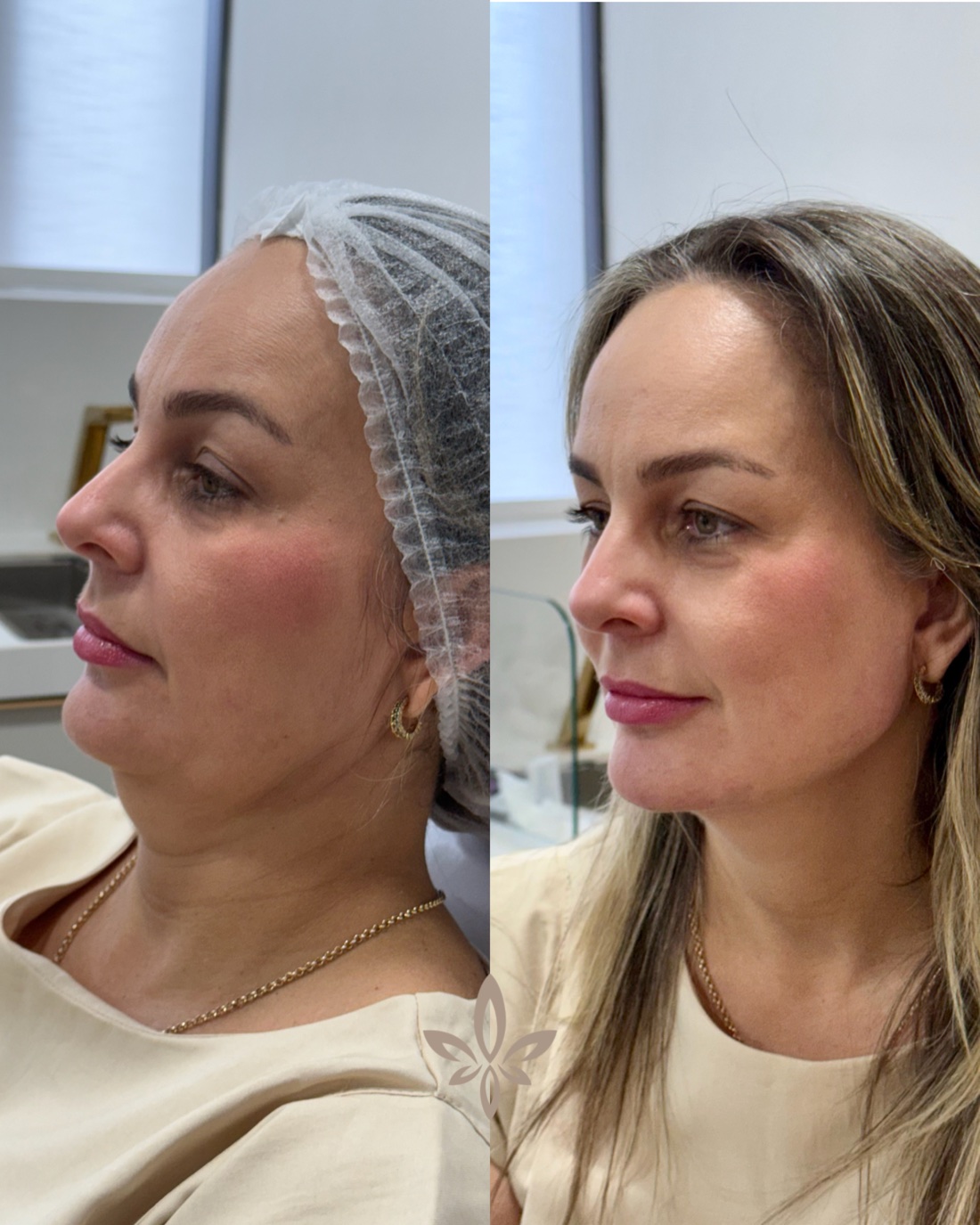Antes e depois de paciente do Método Éclair