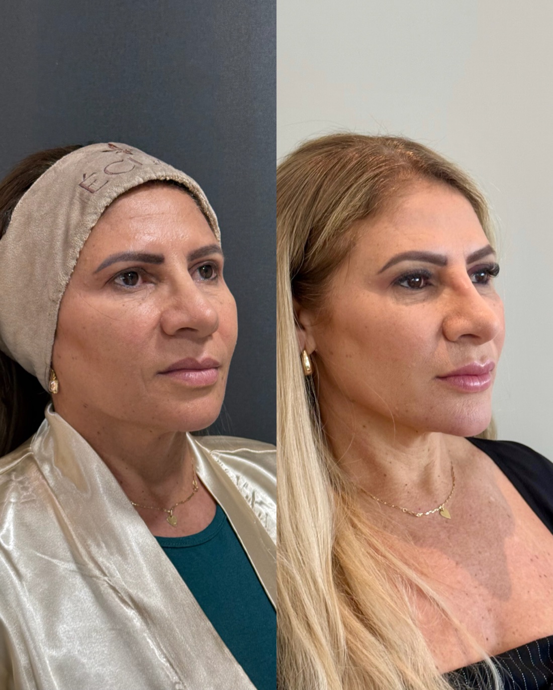 Antes e depois de paciente do Método Éclair