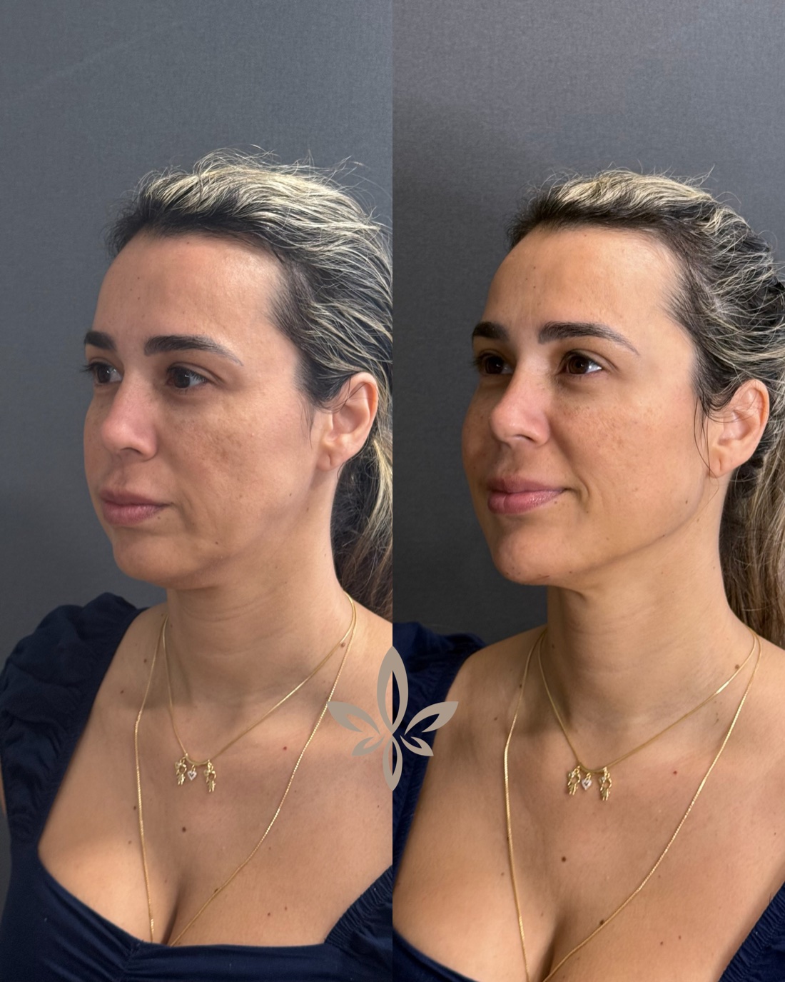 Antes e depois de paciente do Método Éclair